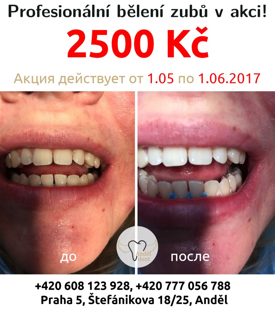 Акция на отбеливание зубов в Праге