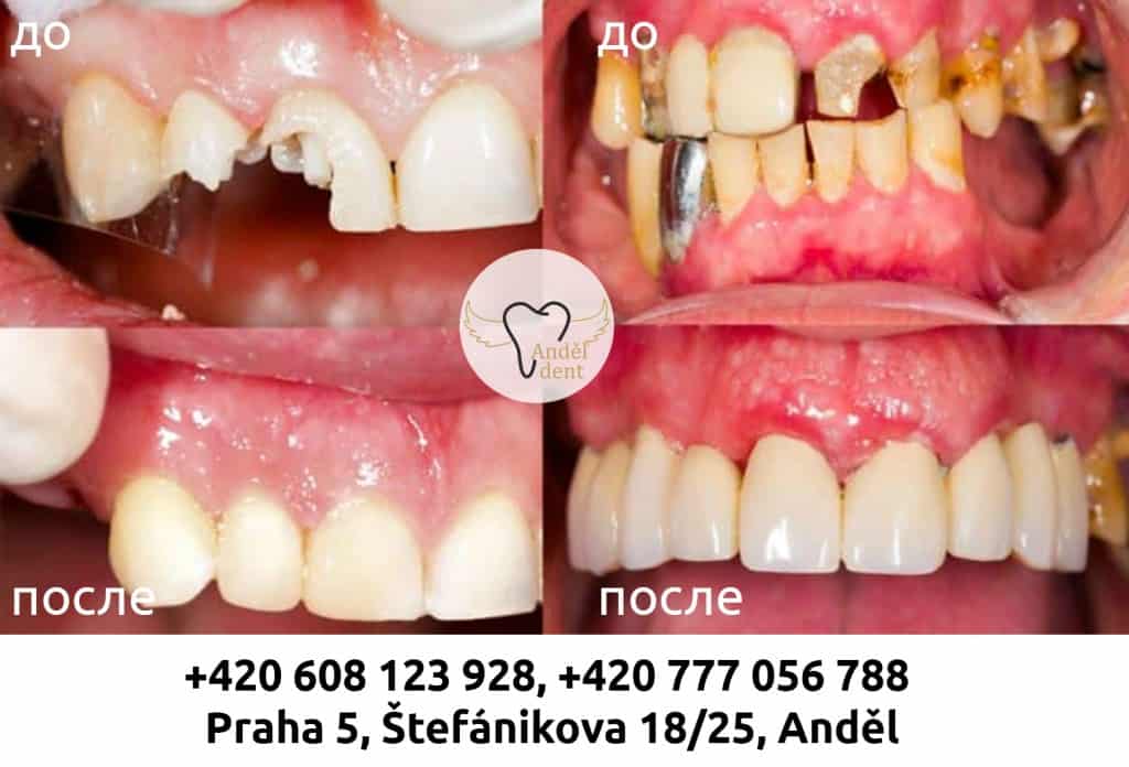 Реставрация зубов в Праге