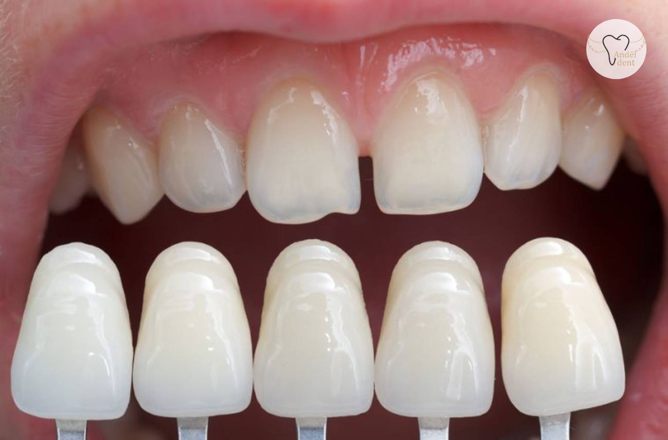Zubní keramické fazety